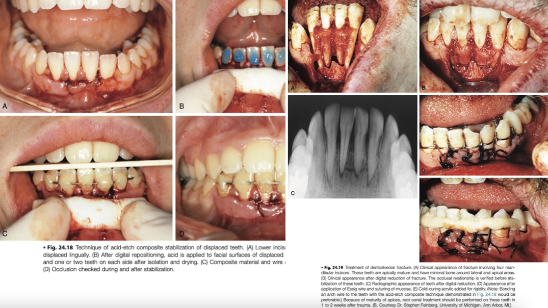 <p>simplest is to<span style="color: red;"> ligate an arch bar</span> to the teeth both mesial and distal to the segment and within the fractured alveolar segment</p><p>use of an <span style="color: red;">acid-etched arch wire →</span> also acceptable</p>