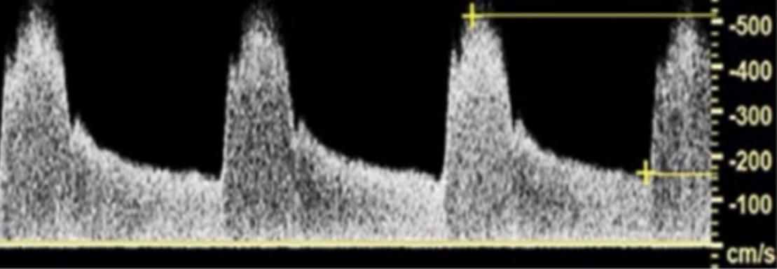 <p>If the systolic is 100cm/sec and the diastolic is 25cm/s, what is the resistive index?</p>