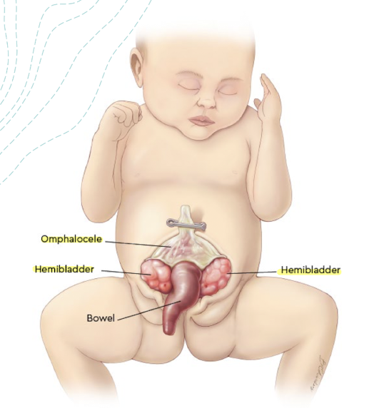 <ul><li><p>more rare, complex, and more extreme</p></li><li><p>condition occurs early in development that involves the primitive gut and persistent cloaca</p></li><li><p>defects urethra, bladder, and bowel are present</p></li><li><p>results in:</p><ul><li><p><span style="color: red;">exstrophy of the bladder</span> (with <span style="color: red;">2 hemibladders</span> separated by muscosa)</p></li><li><p><span style="color: yellow;">omphalocele</span> (upper part of defect)</p></li><li><p>lower abdominal wall defect</p></li></ul></li></ul><p></p>