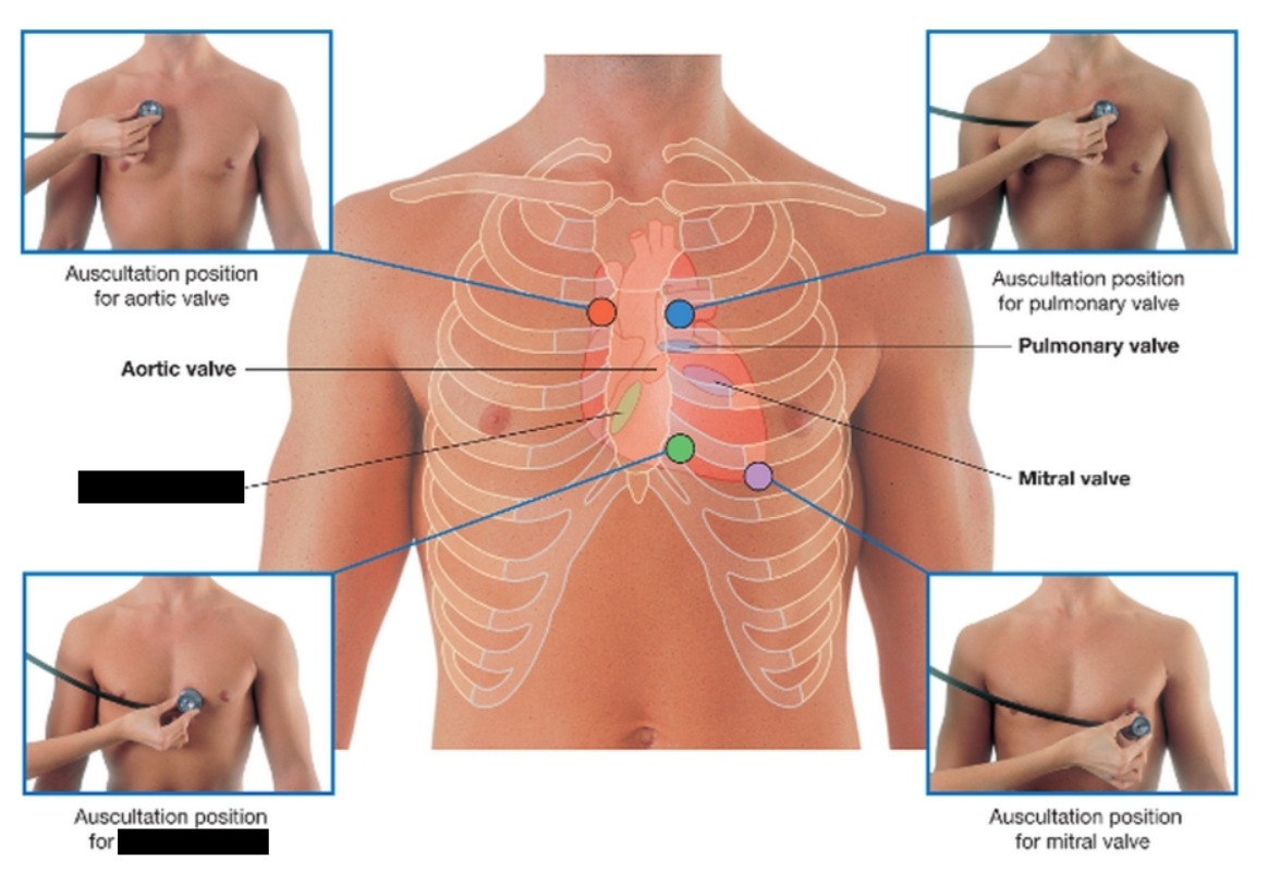<p>a one-way heart valve situated between the right atrium and right ventricle. Its three flaps (leaflets) open to allow deoxygenated blood to flow into the ventricle and close tightly to prevent backward flow when the heart pumps the blood to the lungs</p>