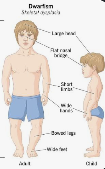 <p>Is Achondroplasia random?</p>