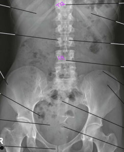 <ul><li><p>T12 to pubic symphysis</p></li><li><p>L4 at center (iliac crest)</p></li><li><p>Psoas muscles</p></li></ul><p></p>