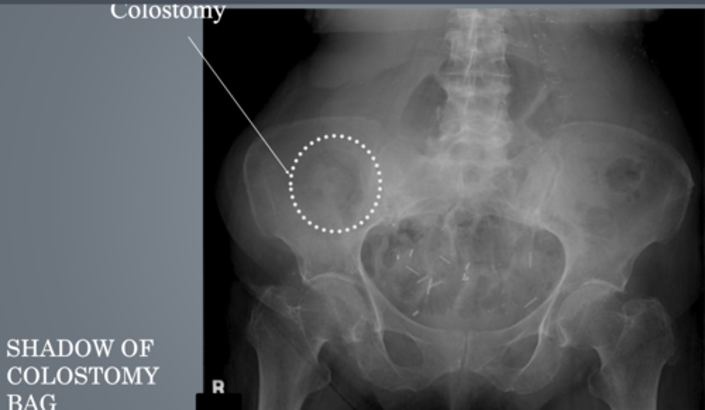 <p>connection between colon and external abdominal wall</p><p>empties into collection bag</p><p>temporary or permanent</p>