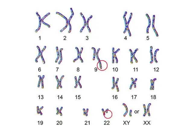 <p>philadelphia chromosome*</p>