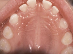 <p>small tooth size, often associated with hypodontia, small lateral incisor = peg lateral  </p>