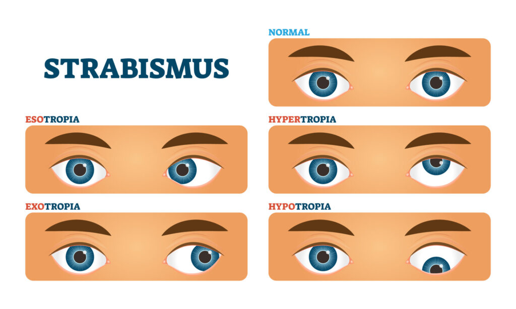 <p>cross eyed or squint/ disparity of eye axes</p>