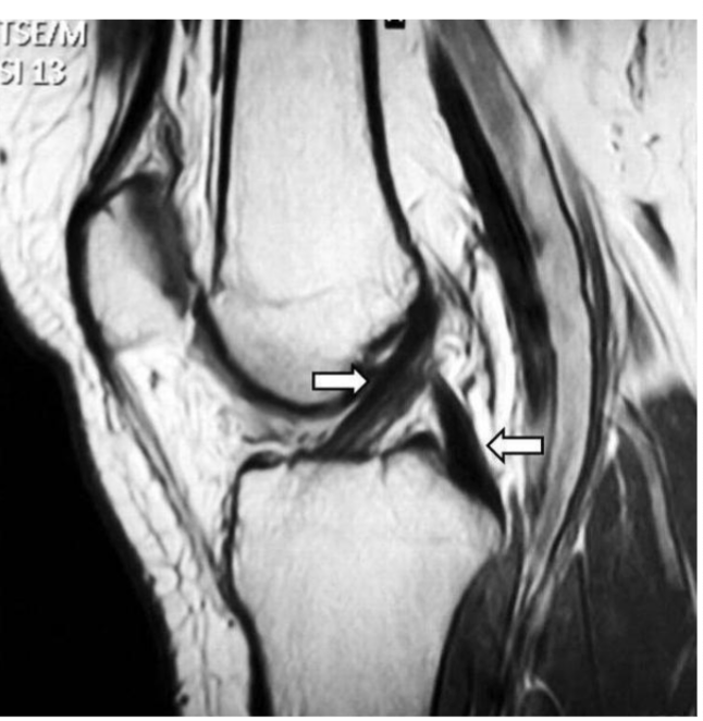 <p>Primary:</p><ul><li><p>resist anterior shear on tibia (b/c insertion is further from origin)</p></li><li><p>resist transverse and frontal combination</p></li></ul><p></p>