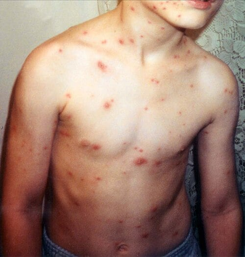 <p>Primary infection with the varicella-zoster virus, which is highly contagious by air and contact</p><p>-Presentation: two day prodrome of low grade fever and malaise, pruritic vesicular rash with lesions in different stages of development from the trunk to face and limbs</p><p>-Dx: clinical </p><p>-Tx: supportive, avoid aspirin in kids, immunocompromised/pregnant adults need acyclovir/valacyclovir </p>