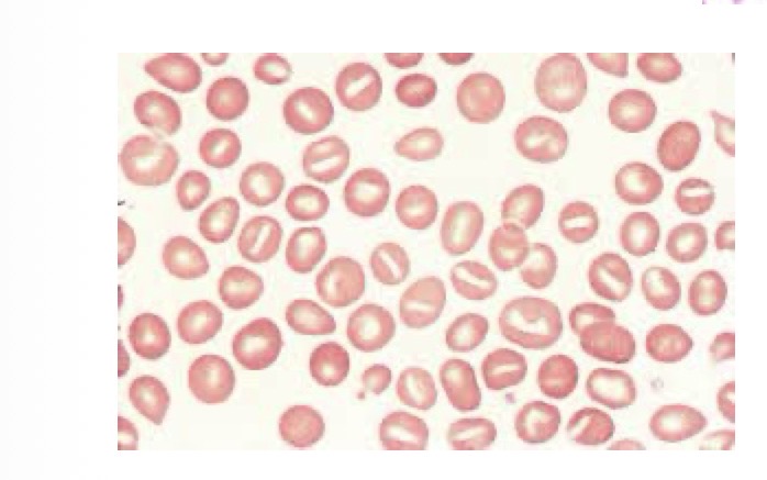 <p>What is hereditary stomatocytois </p>