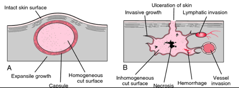<p>Benign:</p><ul><li><p>well differentiated</p></li><li><p>there is no infiltration (capsule) </p></li><li><p>it has slow growth </p></li><li><p>there is no necrosis </p></li></ul><p>Malignant:</p><ul><li><p>is poorly differentiated </p></li><li><p>there is infiltration </p></li><li><p>no capsule </p></li><li><p>fast growth </p></li><li><p>necrotic tissue </p></li></ul><p></p>