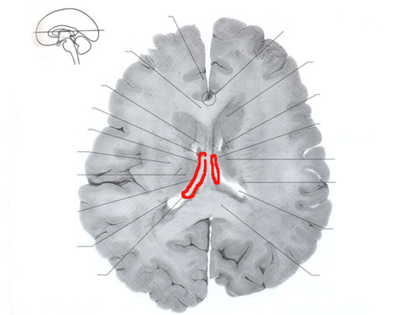<p>Looks like a group of commissural fibers but is actually a tract of arched association fibers.</p>