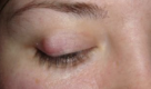 <p><span style="background-color: transparent;">_______</span></p><ul><li><p><span style="background-color: transparent;">Chronic sterile lipogranulomatous inflammation of meibomian gland</span></p></li><li><p><span style="background-color: transparent;">Painless and away from eyelid margin</span></p></li><li><p><span style="background-color: transparent;">Associated with Demodex brevis infection but its role in etiology is not clear</span></p></li><li><p><span style="background-color: transparent;">Sxs</span></p><ul><li><p><span style="background-color: transparent;">Hard painless growth w/o redness that develops over _______</span></p></li><li><p><span style="background-color: transparent;">Much more common in _______</span></p></li></ul></li></ul><p></p>