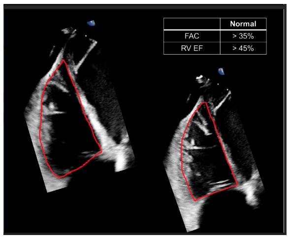 <p><br>*RV Fractional Area Change (FAC)</p><p></p><p>- trace along RV endocardium, including RV trabeculations, papillary muscles & mod band in RV area</p><p></p><p><strong>timing</strong></p><p>- ventricular end-diastole: one frame after TV closure or when RA is at its largest</p><p>- ventricular end-systole: one frame immediately preceding MV opening or when LV is at its smallest</p>