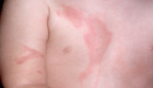 <p>1st degree burn (superficial thickness) sx*</p>