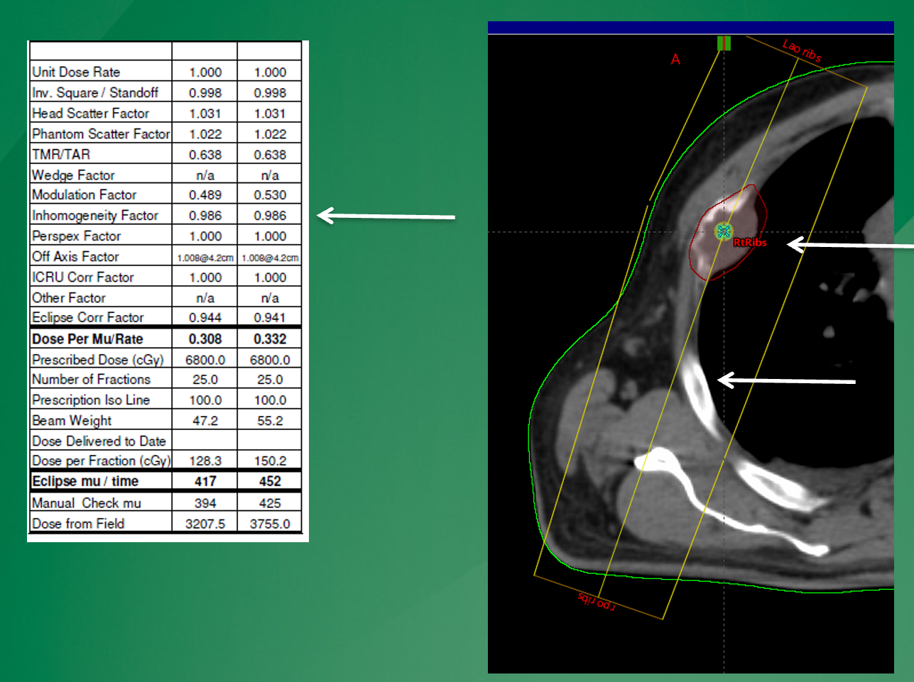 <p>why may the 1D calculation (left) show a different MU value than the Eclipse calculation on the right?</p>