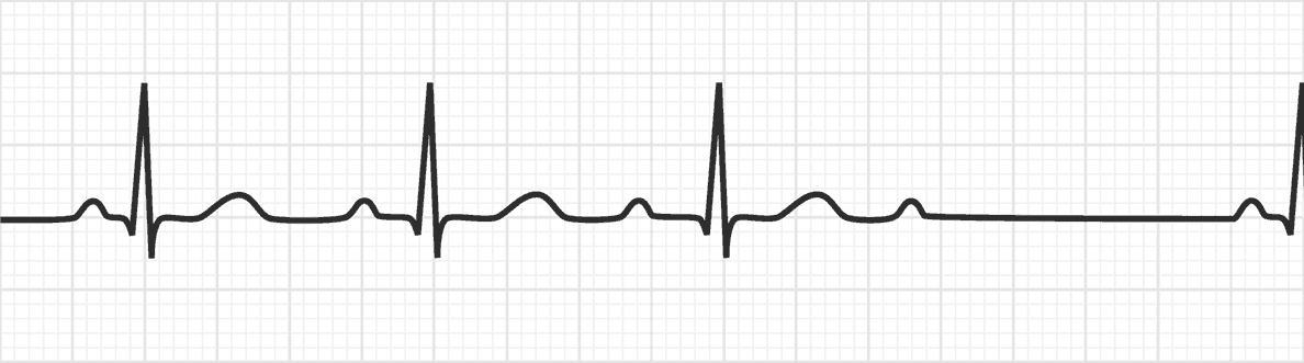 <p>Second degree heart block Mobitz Type I (Wenckebach)</p>