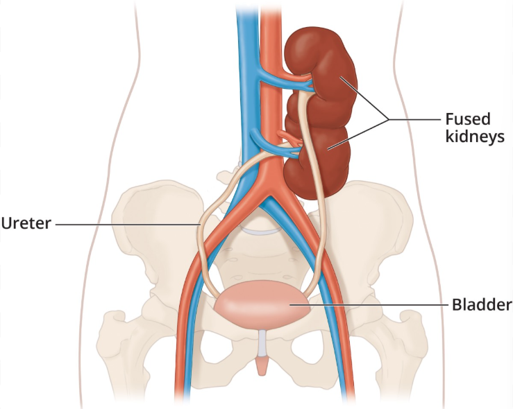 <p>What renal congenital anomaly is when the right and left kidneys are fused and located on one side?</p>