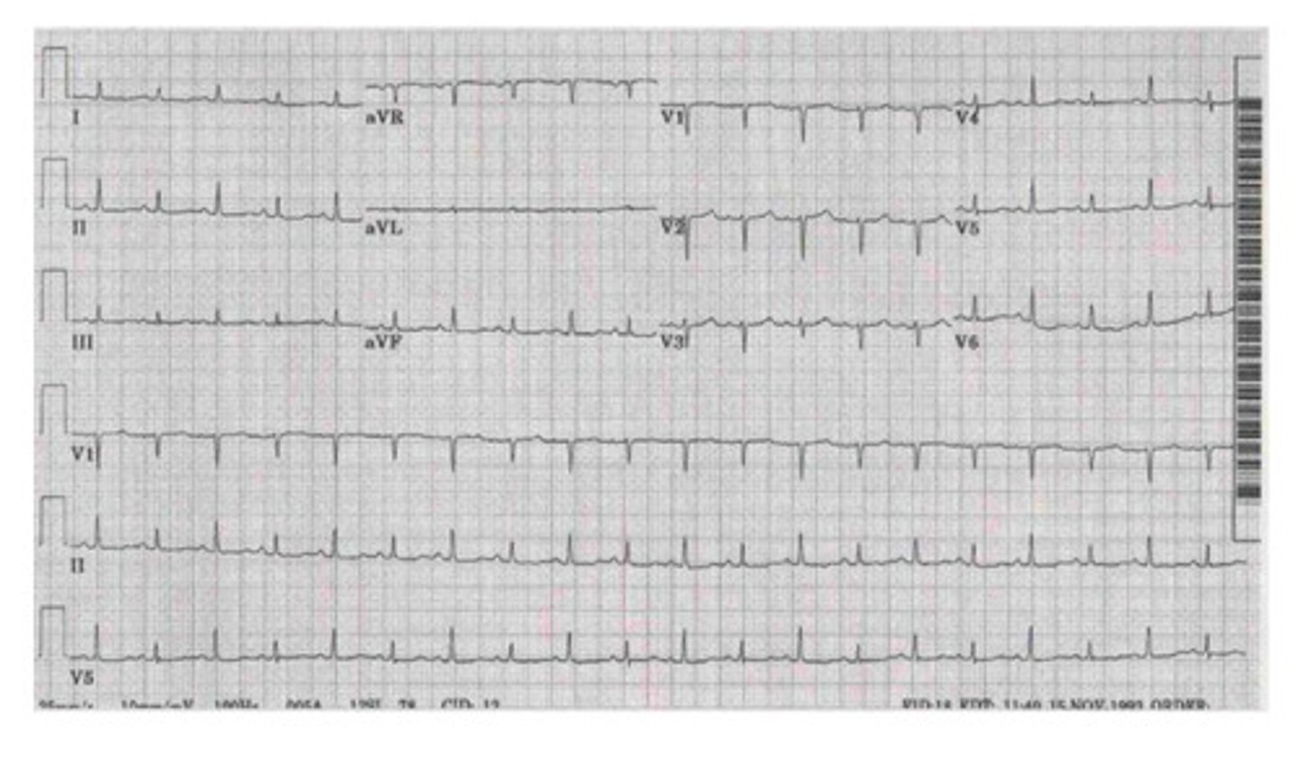 <p>what is this? hint: low voltage &amp; electrical alternans</p>