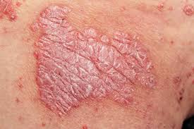 <p>papules coalesce to form an area >1cm (psoriasis)</p>