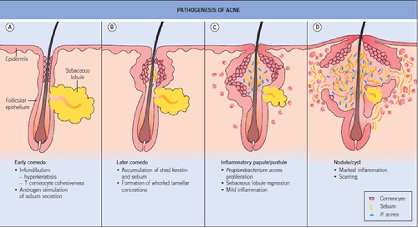 <p>Pores surrounding hair are clogged by excess sebum and dead skin resulting in perifollicular inflammation and eventual rupture of the follicular wall.</p>