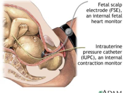 <p>Intermittent Auscultation with Fetoscope</p><p>Electronic fetal monitoring</p><p>- External Fetal Monitoring</p><p>- Internal Fetal Monitoring</p>