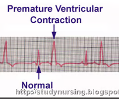 <p><span>premature ventricular complexes</span><br><span>*tx usually based on cause and usual benign finding</span></p>
