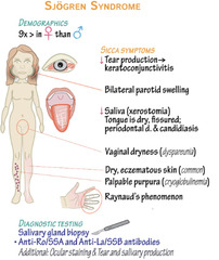 <p>Sjogren's syndrome</p>