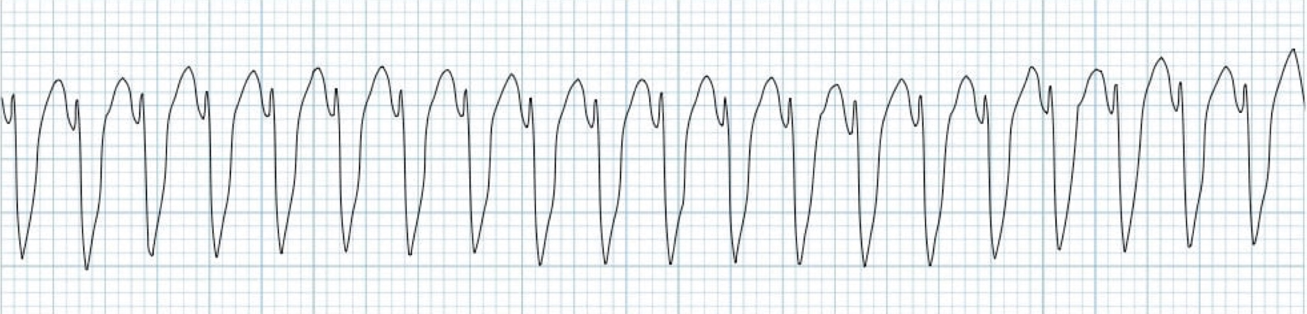 <p>What rhythm/abnormality is seen below?</p>