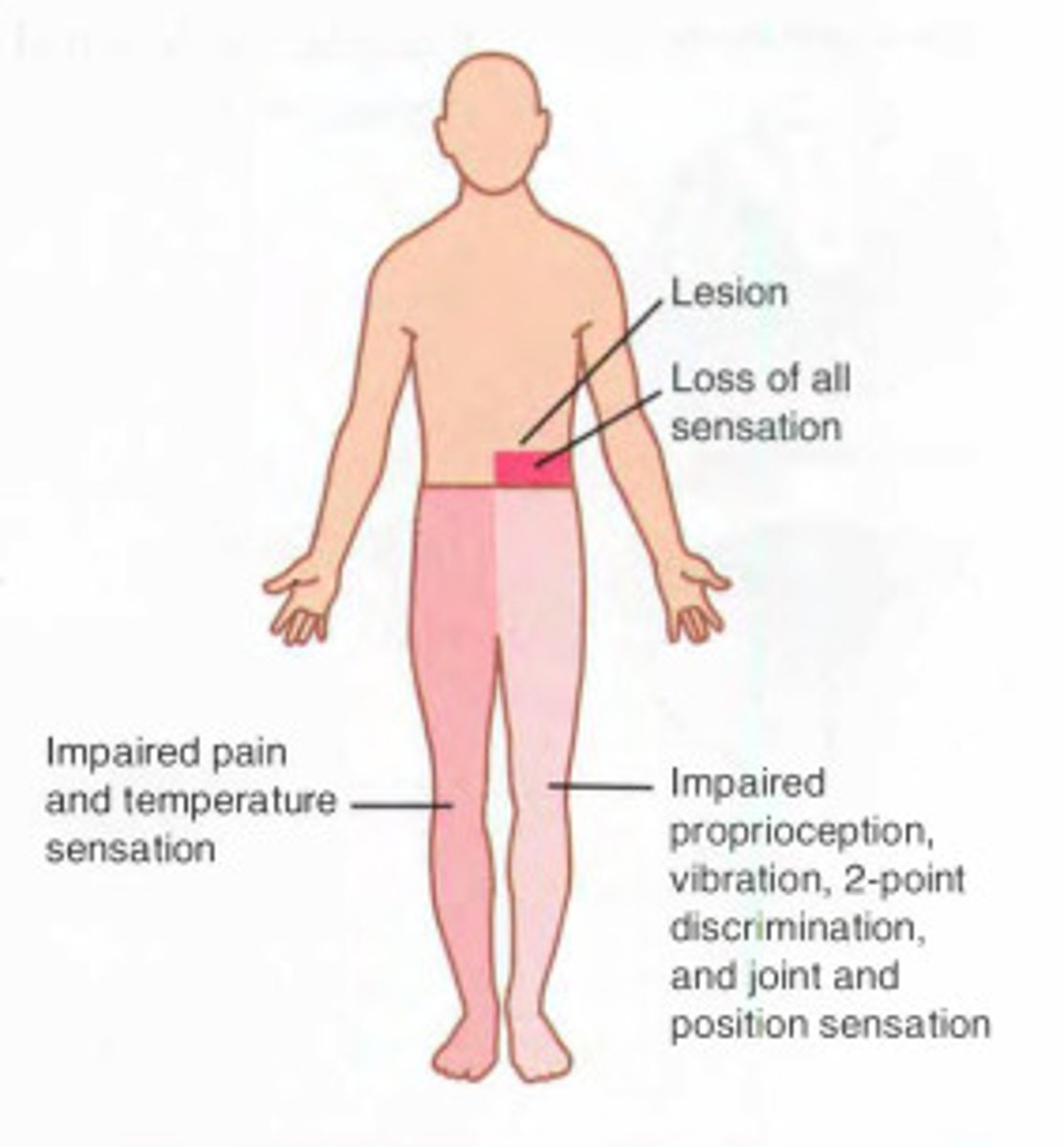 <p>loss of pain and temperature, contralateral side, loss of vibration and position discrimination on ipsilateral side</p>