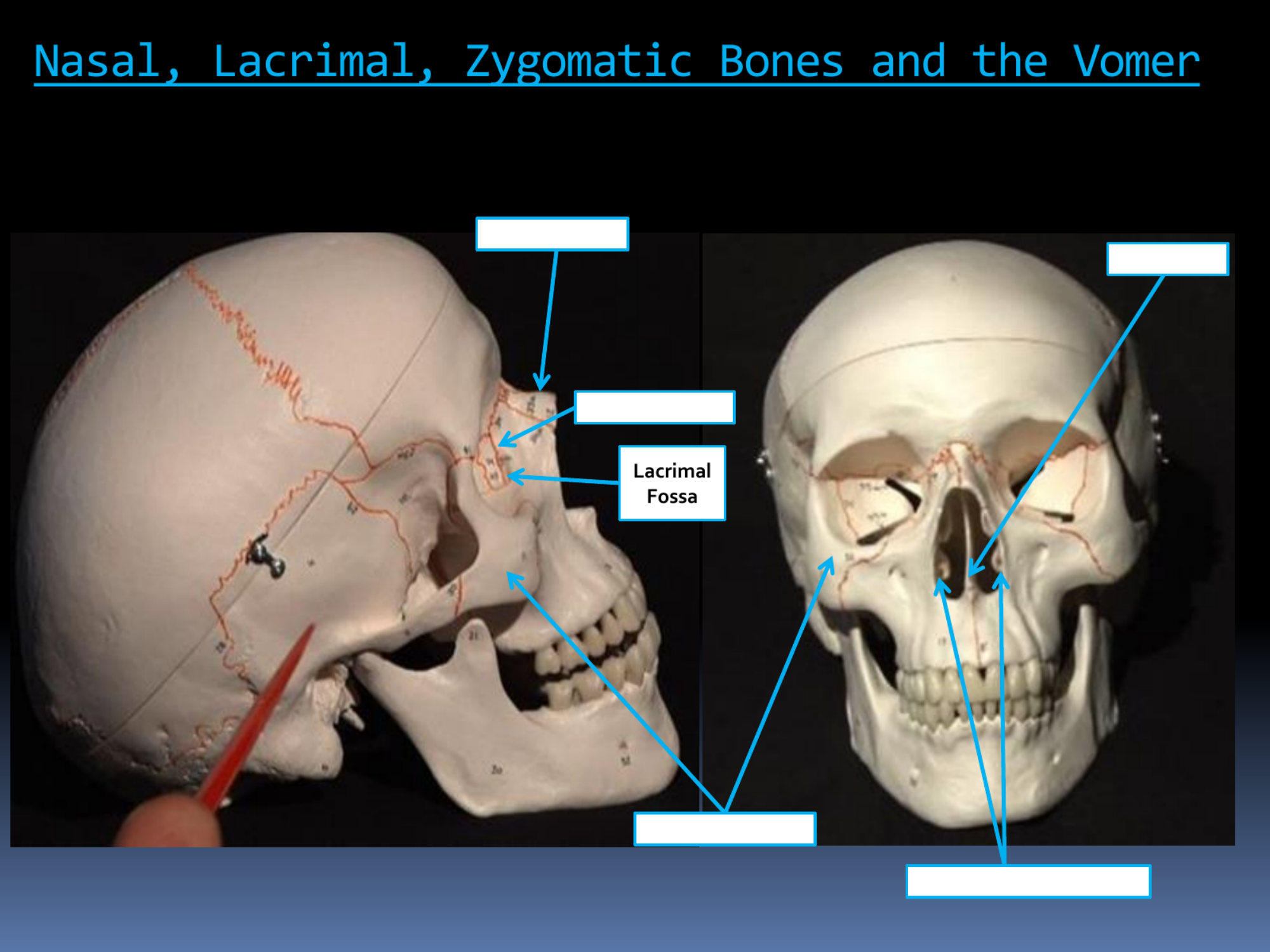 <p>Lacrimal Fossa</p>