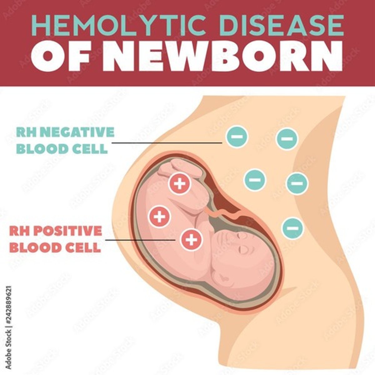 <p>HDN occurs when an Rh-negative mother carries an Rh-positive fetus, leading to the mother producing anti-D antibodies that can agglutinate fetal erythrocytes.</p>