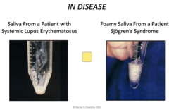 <p>- Systemic Lupus Erythematosus</p><p>- Sjögren's Syndrome</p>