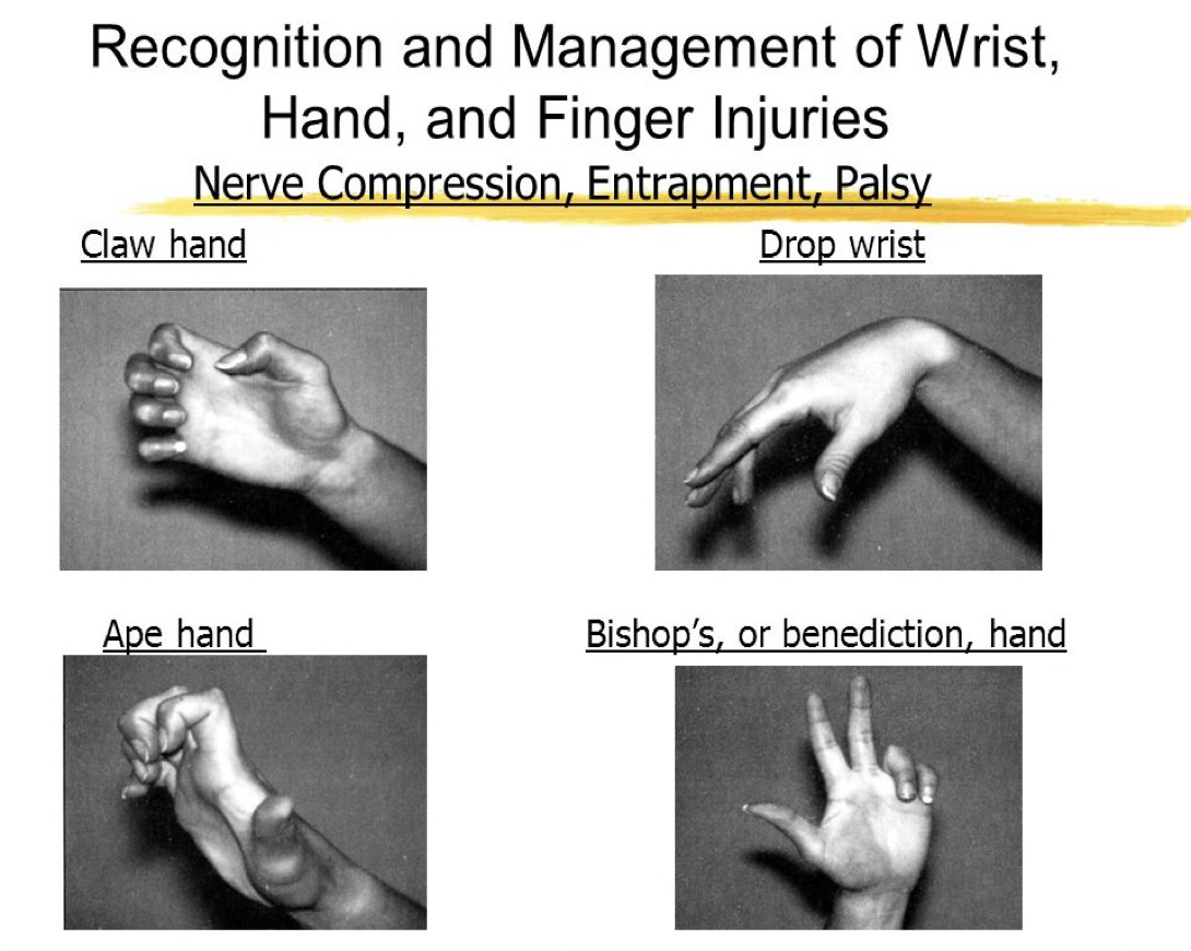 <p>nerve compression symptoms</p>
