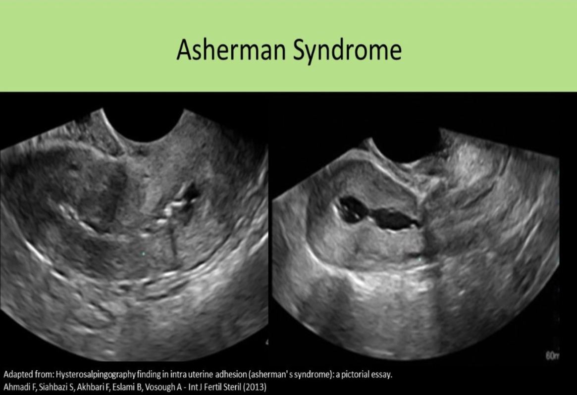 <p>C. Asherman</p><p>Asherman syndrome refers to intrauterine adhesions of the endometrial lining caused by C-section or D&amp;C. It is related to reduced fertility and increased risk of miscarriage.</p>