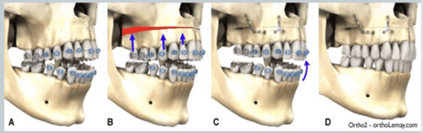 <p>What type of surgery does this show?</p>