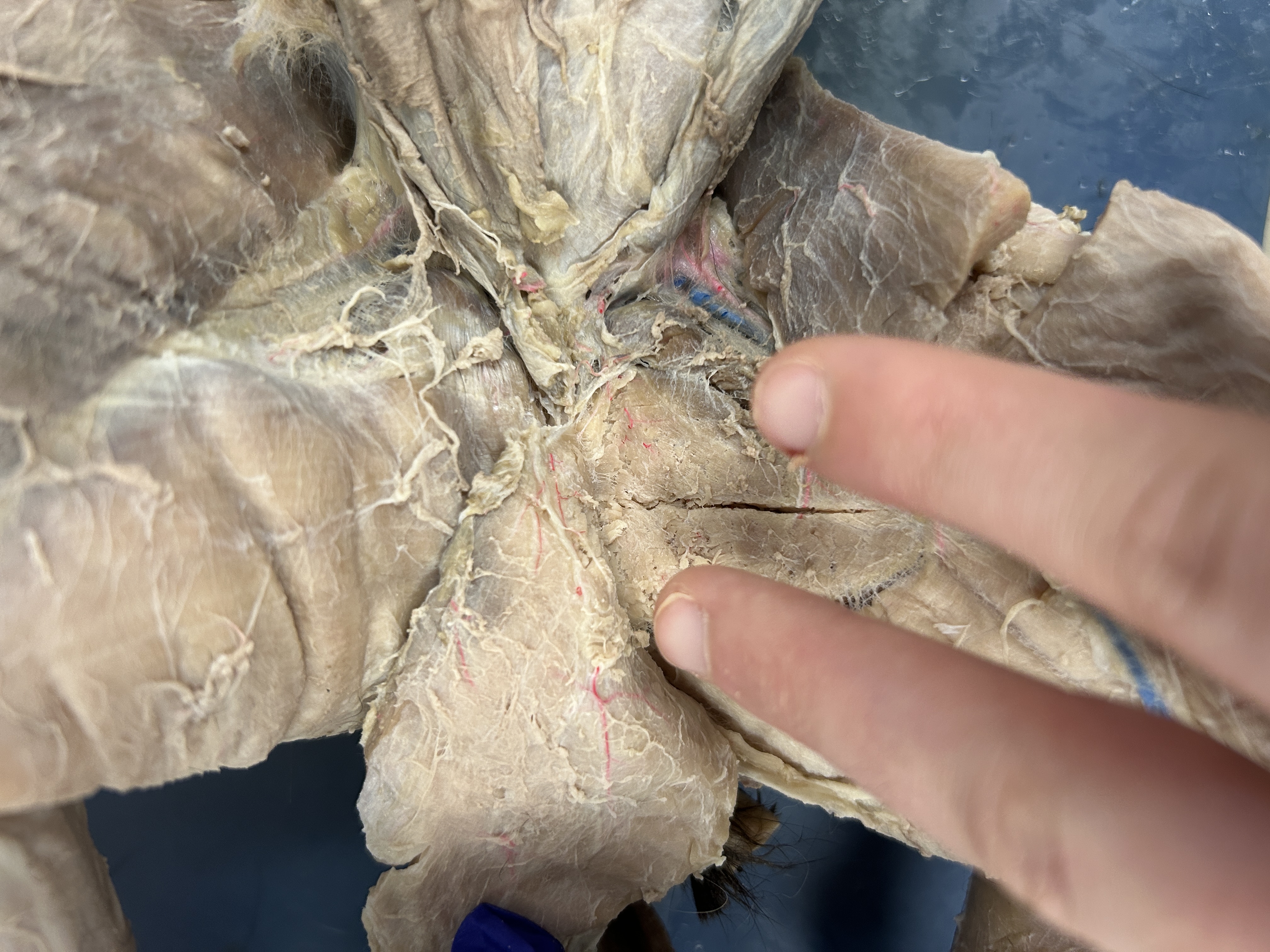 <p>Adductor Femoris (section split into two)</p>