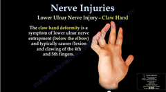 <p>ulnar nerve</p>