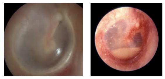 <p><span><span>•Fluid in middle ear space</span></span></p><p class="s178"><span><span>•Increases stiffness (smaller air space, reduces compliance), so creates low-frequency hearing loss</span></span></p>