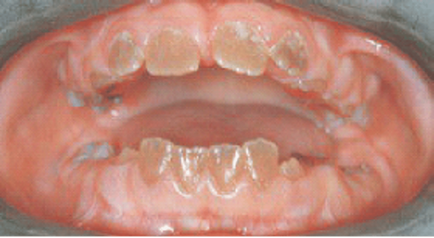 <p><br><span>incomplete or improper development of dentin tissue, between enamel and cementum</span></p>