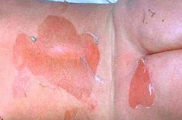 <p>Causative Agent: Staphylococcus aureus possessing exfoliative toxin A and B gene<br>Symptoms/Signs: Fever, Blisters, Large areas of skin peeling, painful skin, redness</p>