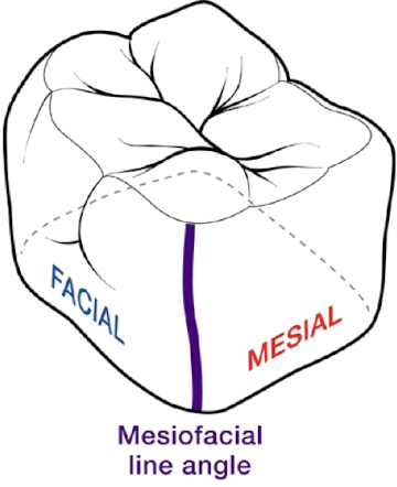 <p>Where the facial and mesial surfaces meet</p>