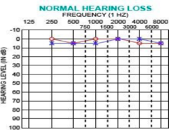 <p>anything about 20 dB is normal </p><p>this is an example of a normal hearing test</p>