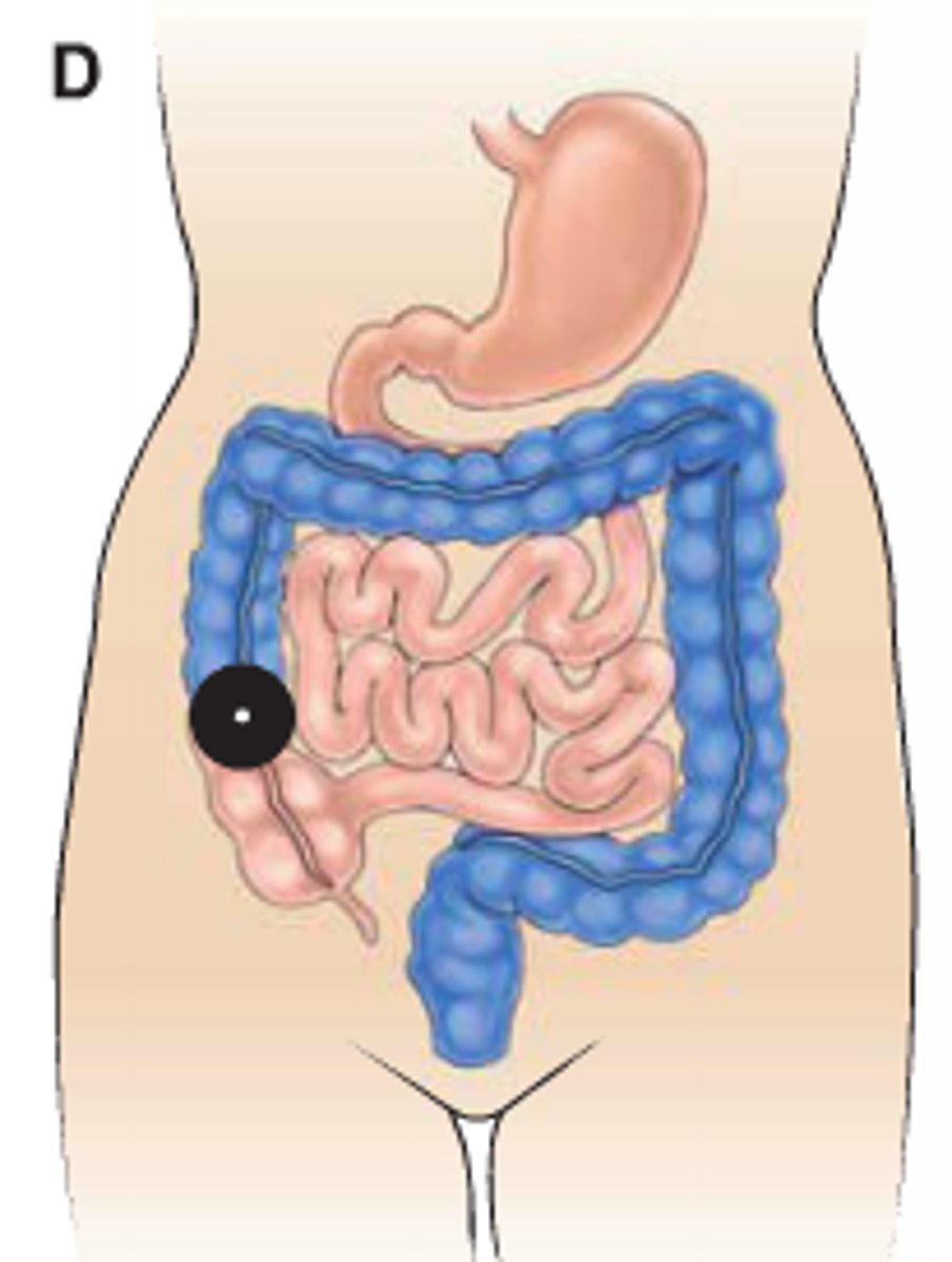 <p>colostomy</p>