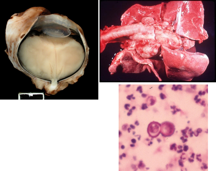 <ul><li><p><strong>pyogranulomatous endophthalmitis & chorioretinitis</strong></p></li><li><p>retinal detachment</p></li><li><p>thick-walled yeast, broad-based budding</p></li><li><p>systemic disease: lungs, skin, bone, eye</p></li></ul><p></p>