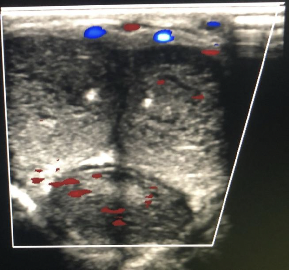 <p>Find the area where the urethra would normally be found</p>