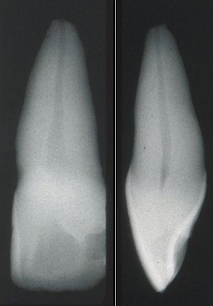<p>What is the root shape of central incisors?</p>
