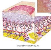 <ul><li><p>Plateau- flat top </p></li><li><p>>10mm in diameter</p></li><li><p>elevated above skin</p></li><li><p>Well-defined</p></li><li><p>firm and rough</p></li></ul><p></p>