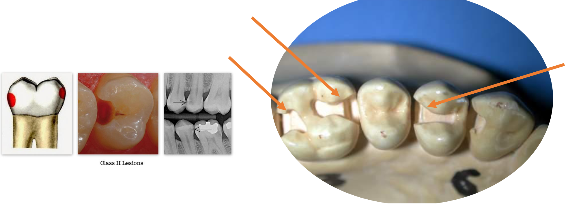 <p>Smooth proximal surfaces of posterior teeth</p><p>(premolars and molars)</p>