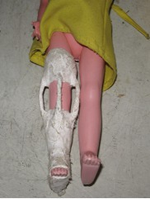 <p><span>severe/massive bone injury</span></p>