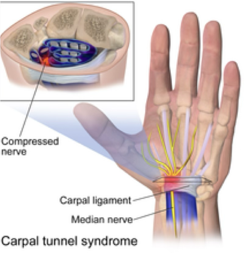 <p>carpal tunnel syndrome symptoms</p>